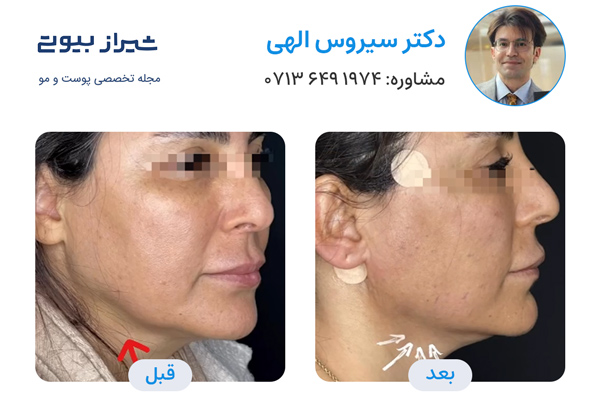 لیفت نخ در شیراز - دکتر سیروس الهی