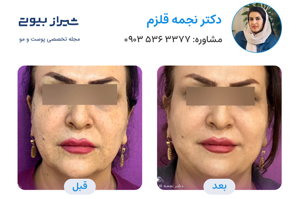 لیفت نخ در شیراز - دکتر نجمه قلزم
