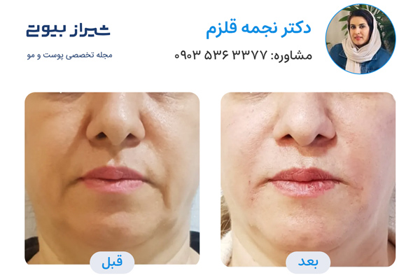 لیفت نخ در شیراز - دکتر نجمه قلزم