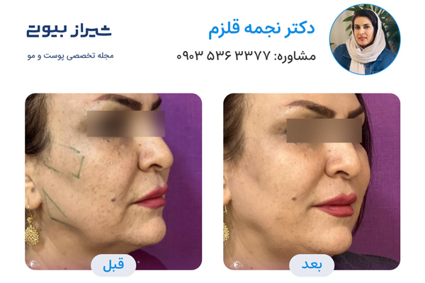 لیفت نخ در شیراز - دکتر نجمه قلزم