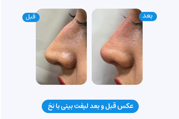 عکس قبل و بعد لیفت صورت در شیراز - نمونه کار 