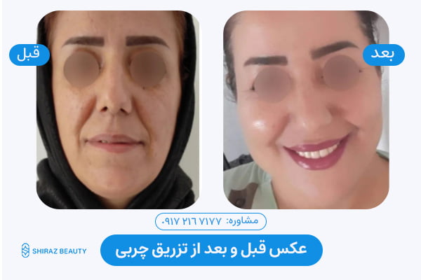 Fat grafting before and after photo 3