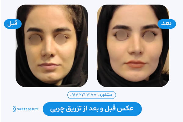 Fat transfer before and after photo