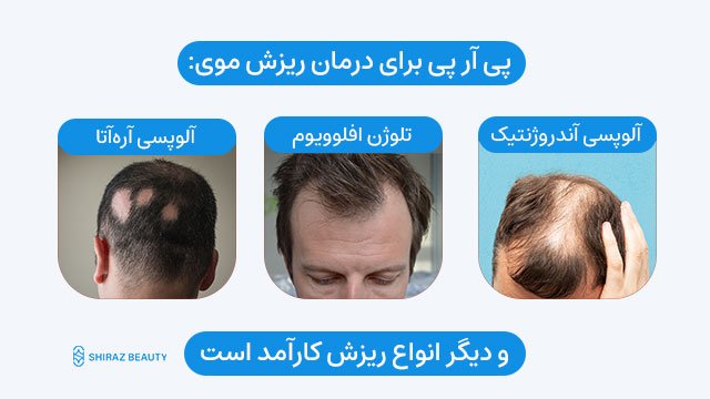 پی آر پی برای درمان ریزش موی، آلوپسی آندروژنتیک، تلوژن افلوویوم، آلوپسی آره‌آتا و دیگر انواع ریزش مو موثر است