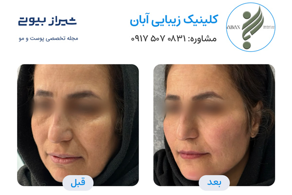 تزریق چربی در شیراز - کلینیک زیبایی آبان
