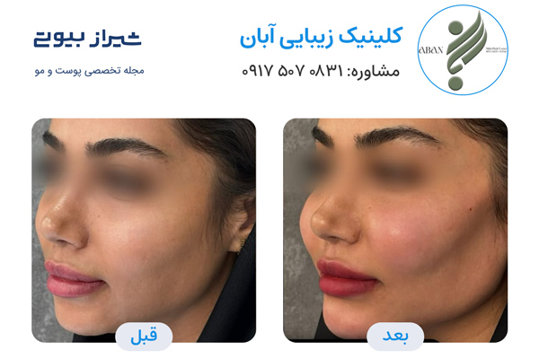 تزریق چربی در شیراز - کلینیک زیبایی آبان
