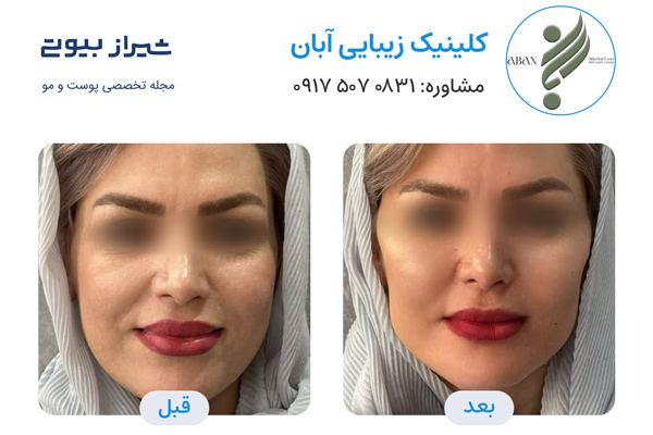 تزریق چربی در شیراز - کلینیک زیبایی آبان