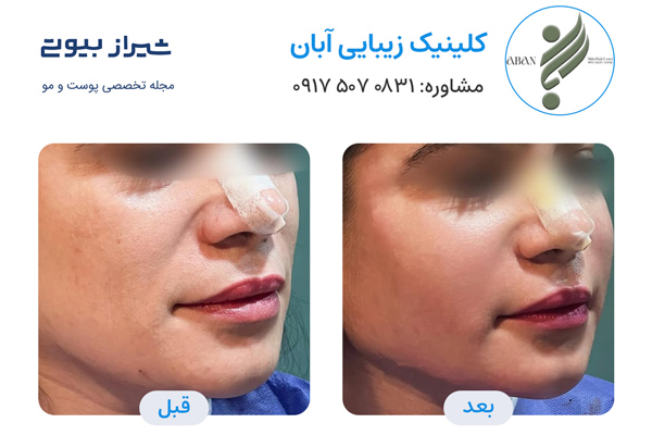 تزریق چربی در شیراز - کلینیک زیبایی آبان