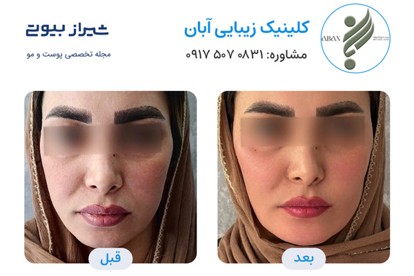 تزریق چربی در شیراز - کلینیک زیبایی آبان