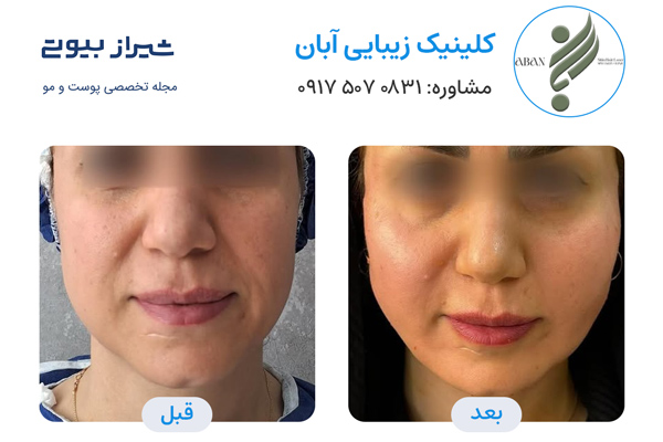 تزریق چربی در شیراز - کلینیک زیبایی آبان