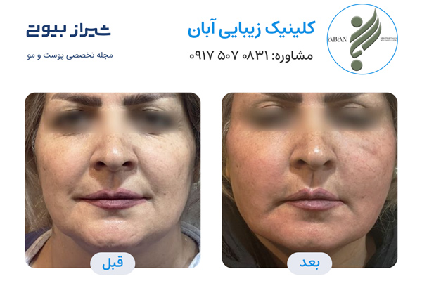 تزریق چربی در شیراز - کلینیک زیبایی آبان