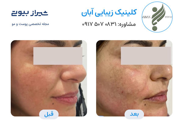 تزریق چربی در شیراز - کلینیک زیبایی آبان