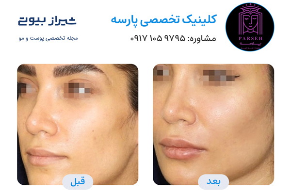 تزریق چربی در شیراز - کلینیک پارسه