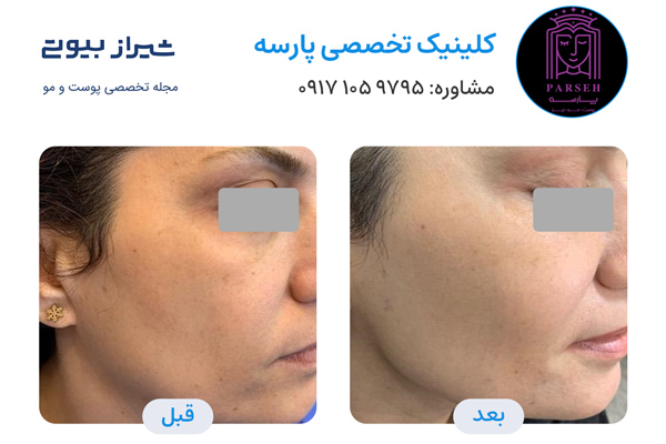 تزریق چربی در شیراز - کلینیک پارسه