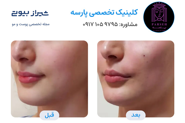 تزریق چربی در شیراز - کلینیک پارسه