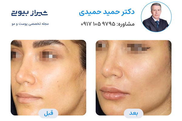 تزریق چربی در شیراز - دکتر حمید حمیدی