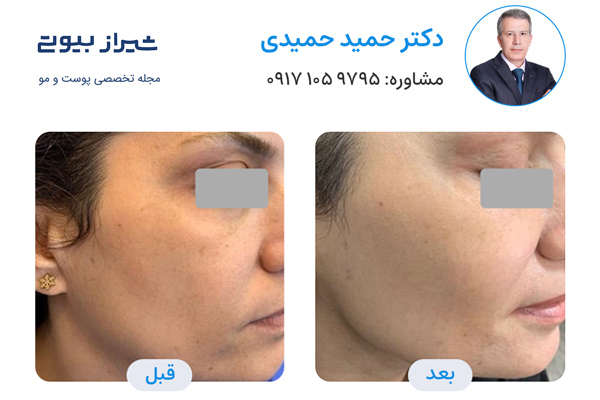 تزریق چربی در شیراز - دکتر حمید حمیدی