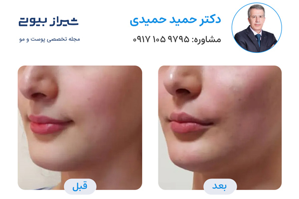 تزریق چربی در شیراز - دکتر حمید حمیدی