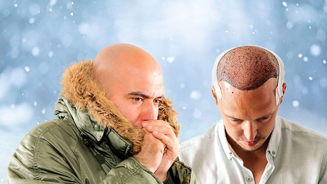 تاثیر سرما و گرما بعد از کاشت مو