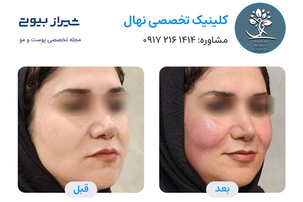 اندولیفت در شیراز - کلینیک تخصصی نهال