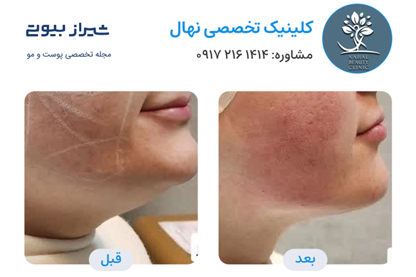 اندولیفت در شیراز - کلینیک تخصصی نهال