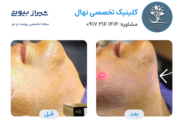 اندولیفت در شیراز - کلینیک تخصصی نهال