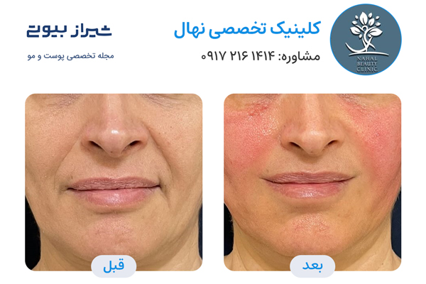 اندولیفت در شیراز - کلینیک تخصصی نهال