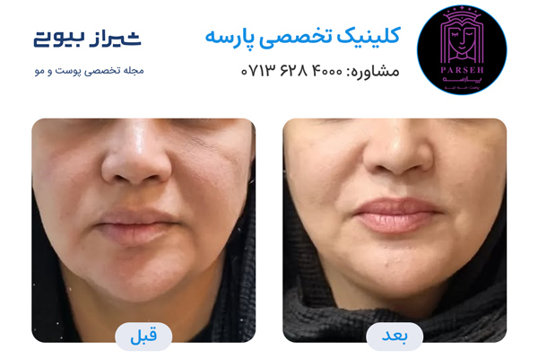 اندولیفت در شیراز - کلینیک پارسه