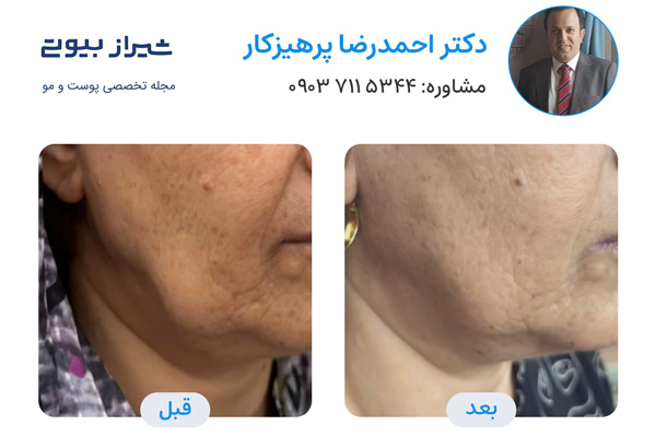 اندولیفت در شیراز - دکتر احمدرضا پرهیزکار