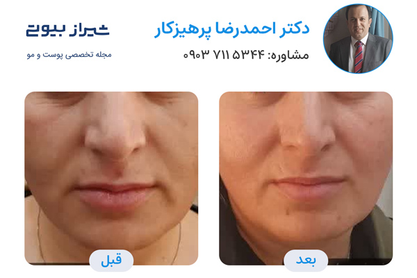 اندولیفت در شیراز - دکتر احمدرضا پرهیزکار