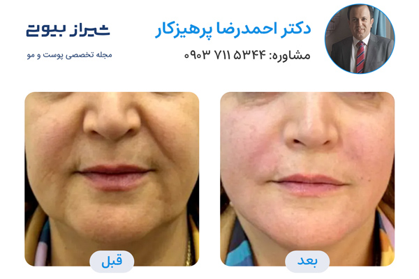 اندولیفت در شیراز - دکتر احمدرضا پرهیزکار