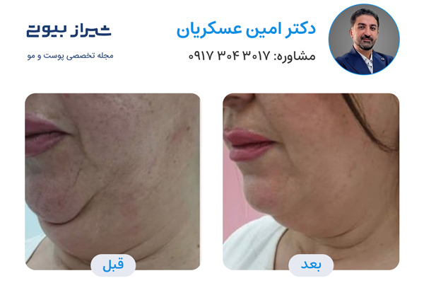 اندولیفت در شیراز - دکتر امین عسکریان