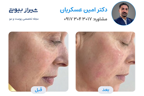 اندولیفت در شیراز - دکتر امین عسکریان