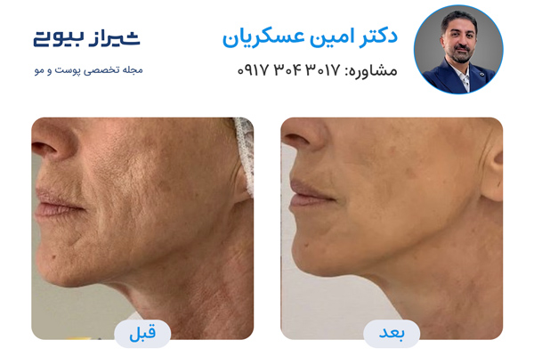 اندولیفت در شیراز - دکتر امین عسکریان
