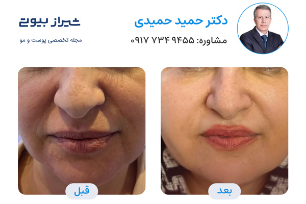 اندولیفت در شیراز - دکتر حمید حمیدی