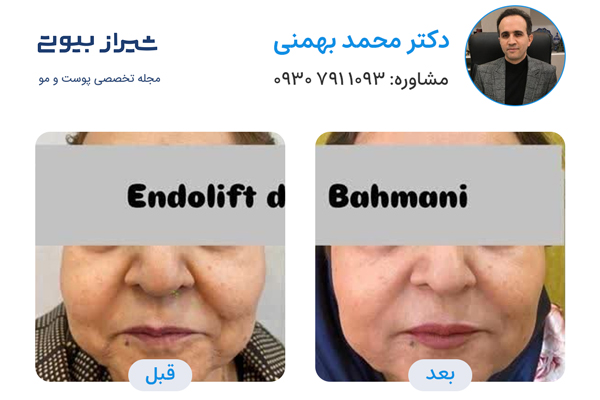 اندولیفت در شیراز - دکتر محمد بهمنی