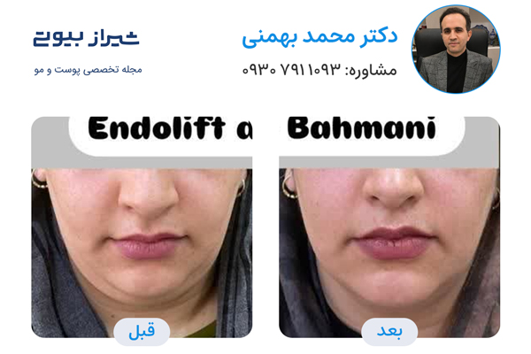 اندولیفت در شیراز - دکتر محمد بهمنی