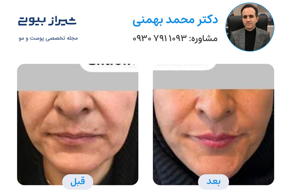اندولیفت در شیراز - دکتر محمد بهمنی