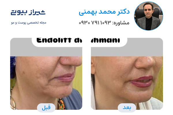 اندولیفت در شیراز - دکتر محمد بهمنی