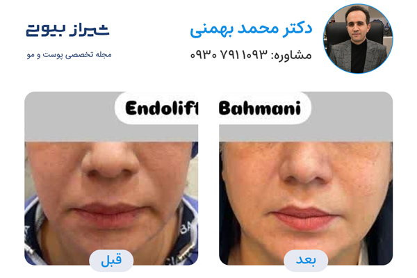 اندولیفت در شیراز - دکتر محمد بهمنی