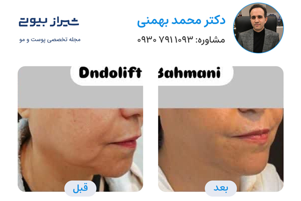 اندولیفت در شیراز - دکتر محمد بهمنی