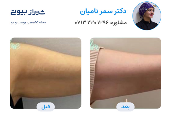 اندولیفت در شیراز - دکتر سمر نامیان