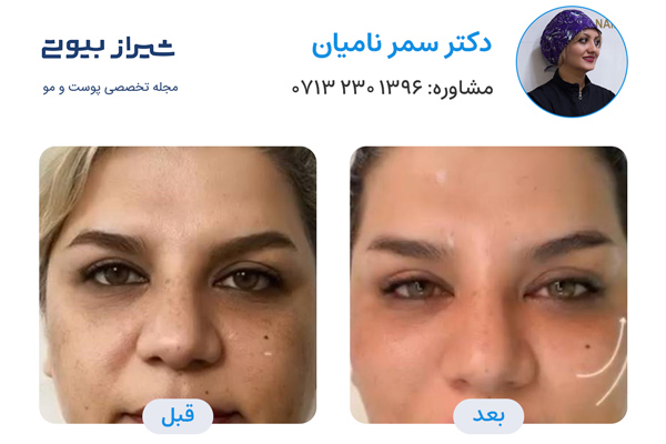 اندولیفت در شیراز - دکتر سمر نامیان