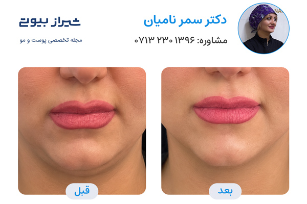 اندولیفت در شیراز - دکتر سمر نامیان