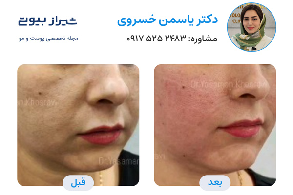 لیزر اندولفیت در شیراز - دکتر یاسمن خسروی