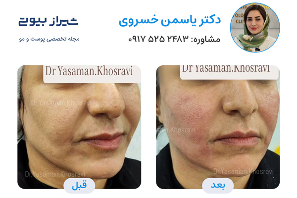 لیزر اندولفیت در شیراز - دکتر یاسمن خسروی