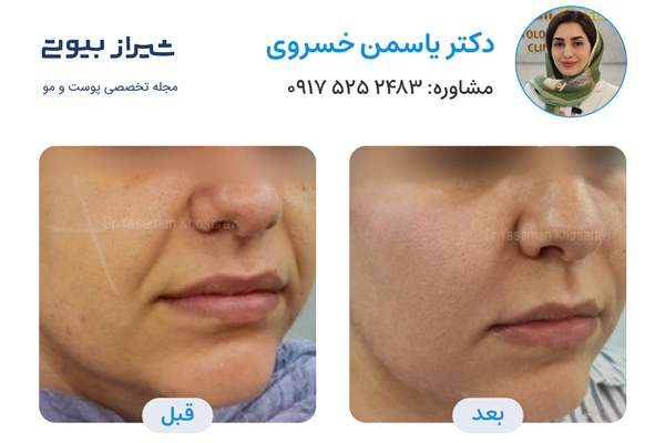 لیزر اندولفیت در شیراز - دکتر یاسمن خسروی