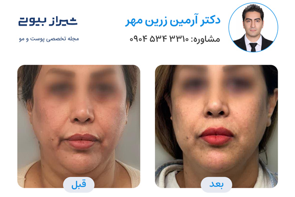 اندولیفت در شیراز - دکتر آرمین زرین مهر