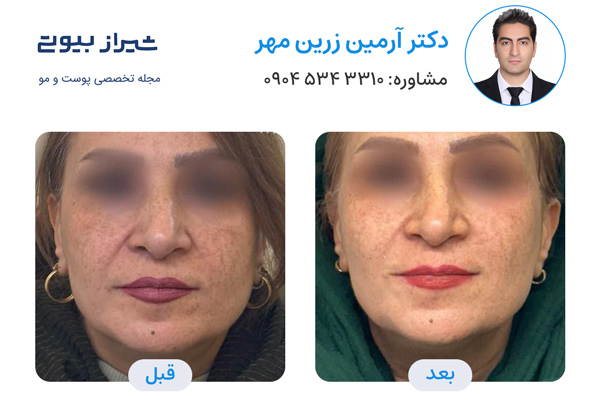 اندولیفت در شیراز - دکتر آرمین زرین مهر