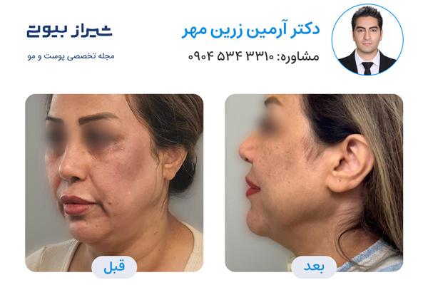 اندولیفت در شیراز - دکتر آرمین زرین مهر